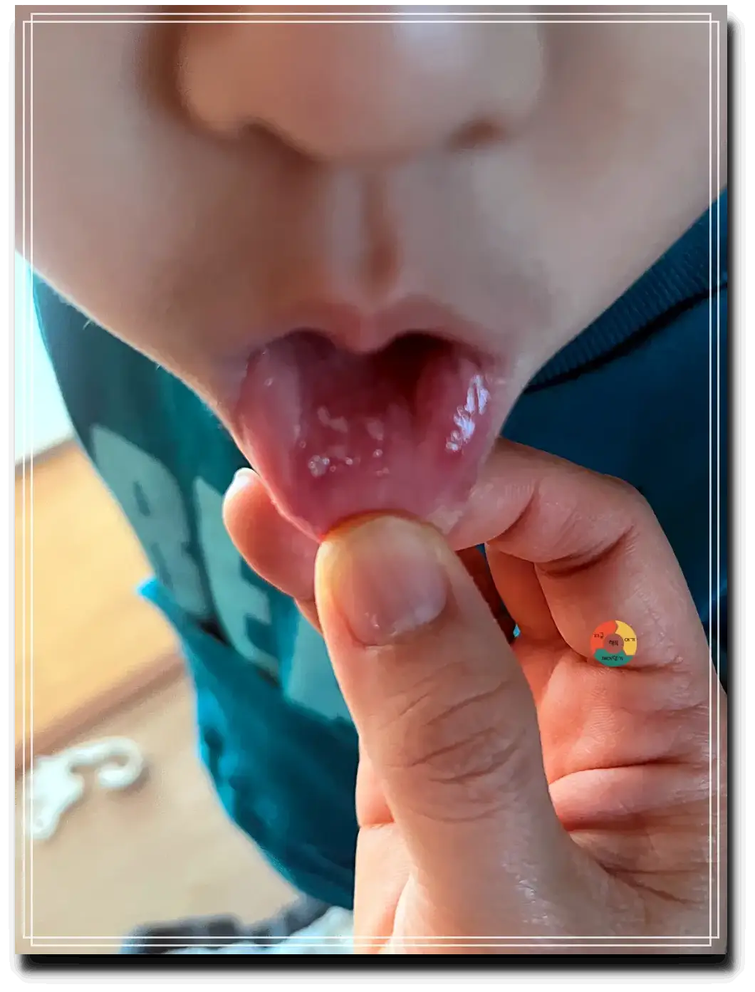 구내염_아랫입술-안쪽-구내염사진