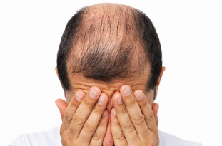 탈모
