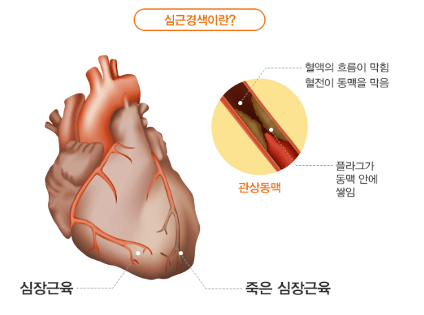 심근경색이란?