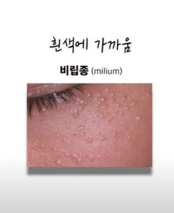 비립종 생기는 이유 비립종 없애는 방법 피부 관리법_8