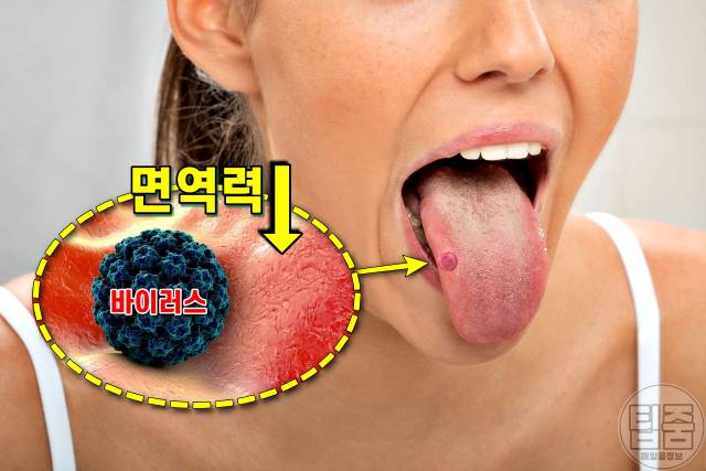 만성탈수 증상,만성탈수 질환,만성탈수 자가진단법,면역력,팁줌