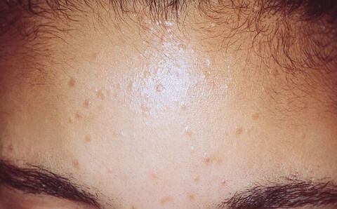 편평사마귀 증상, 원인, 치료