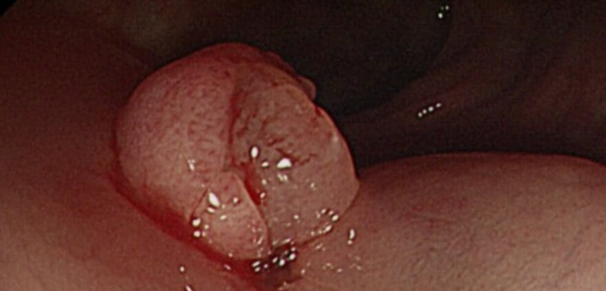 대장내시경 중 용종 발견