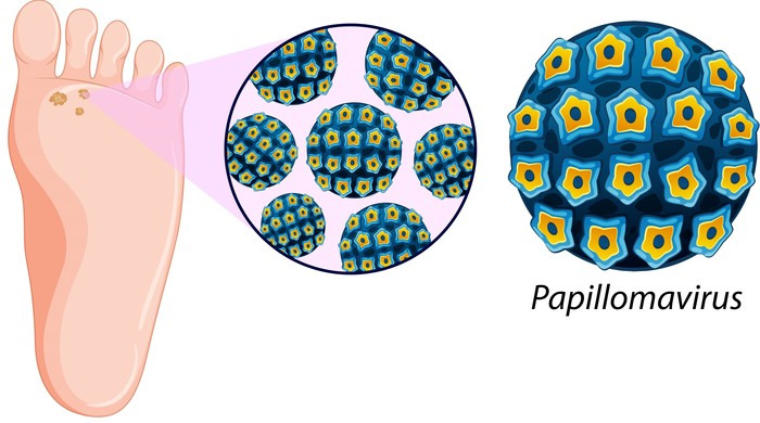 사마귀 원인부터 종류별 증상&middot;치료&middot;관리까지