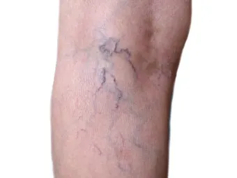 하지 정맥류 증상 치료방법과 예방 생활습관_12