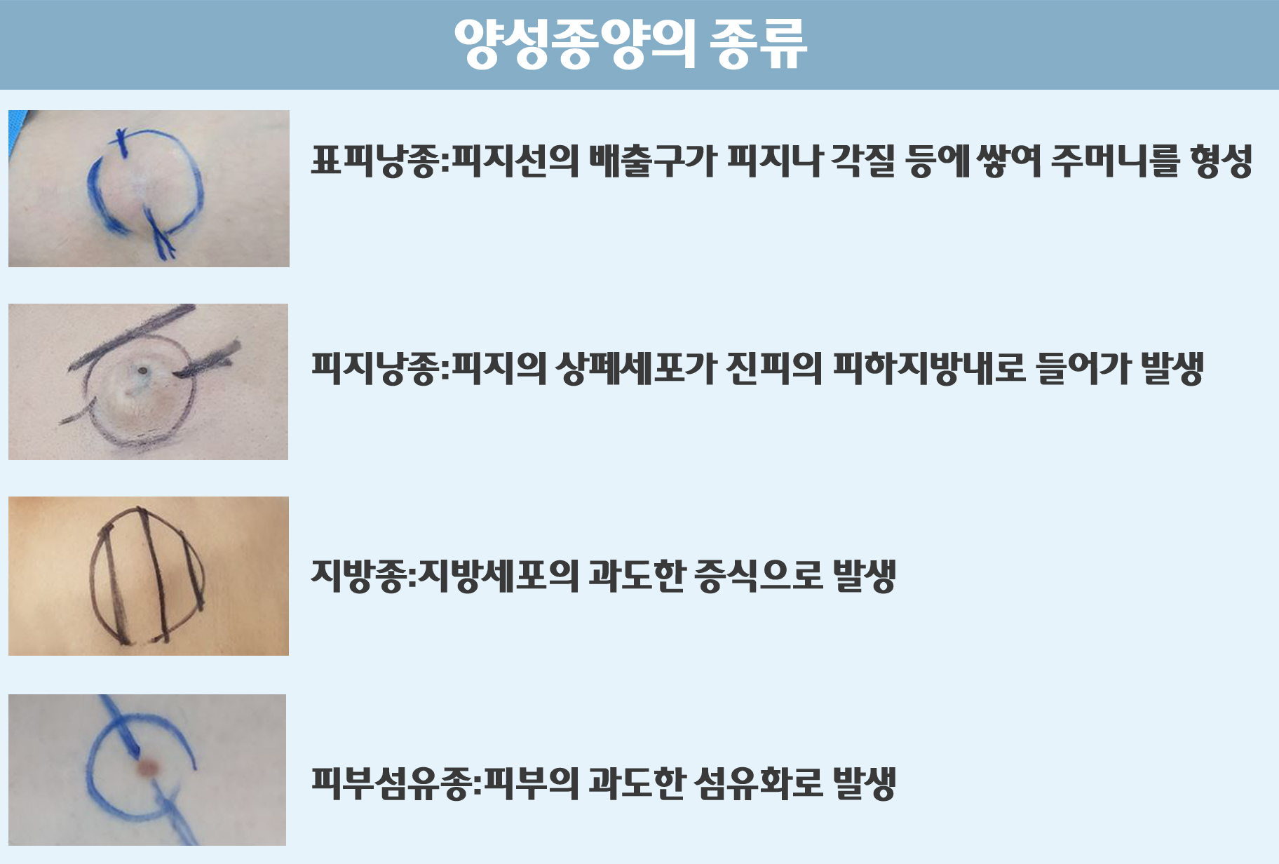 양성종양의 종류