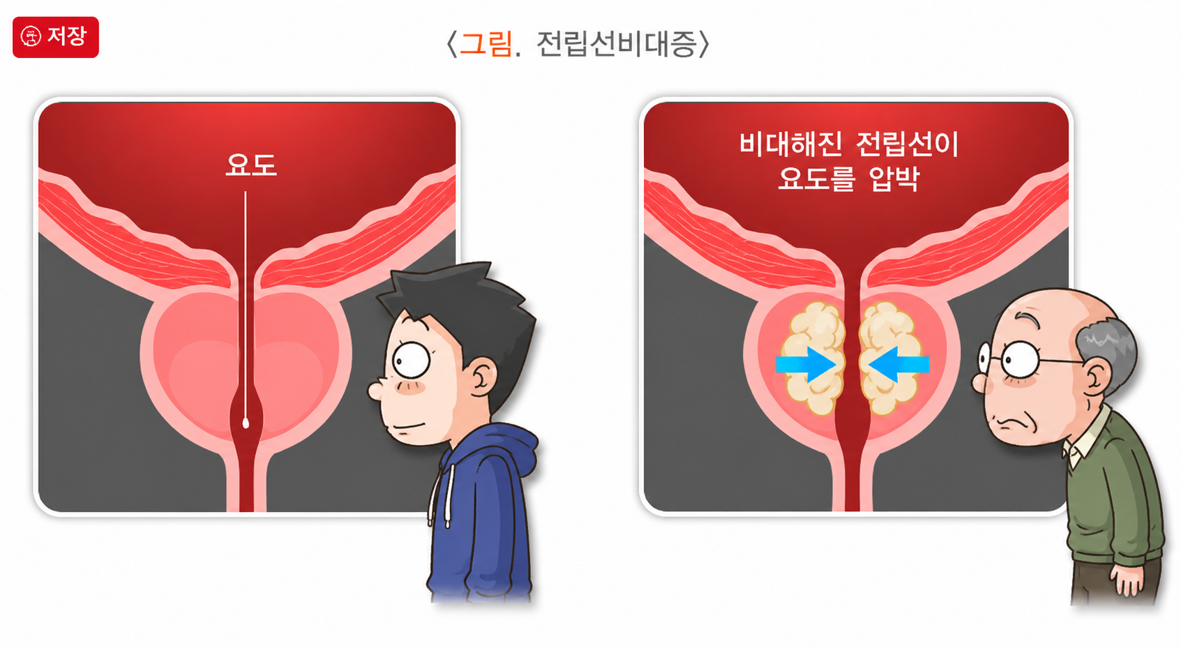 전립선 비대증