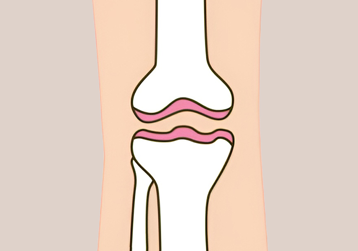 연골이-마모되는-모습
