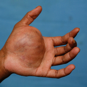 신경섬유종 초기 증상, 혹시 나도? 놓치면 안 되는 신호