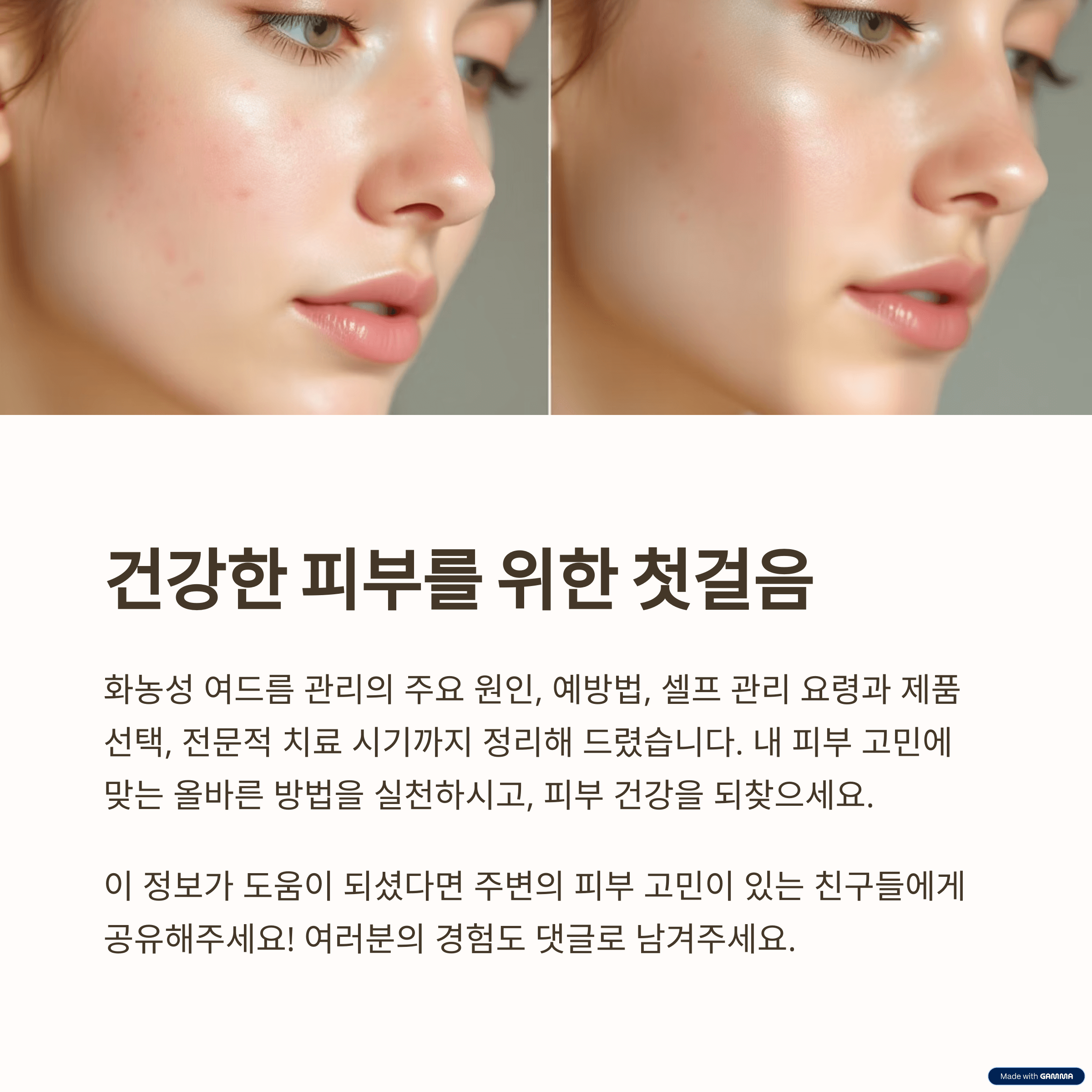 화농성 여드름 관리 FAQ