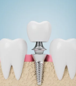 임플란트 모형 사진