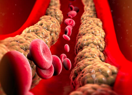 고지혈증 증상&amp;#44; 고지혈증에 좋은 음식&amp;#44; 고지혈증 수치 총정리 (2024ver)