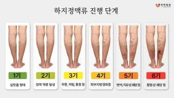 하지 정맥류 증상 치료방법과 예방 생활습관_3