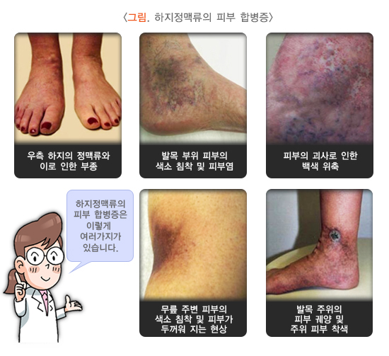 하지정맥류운동