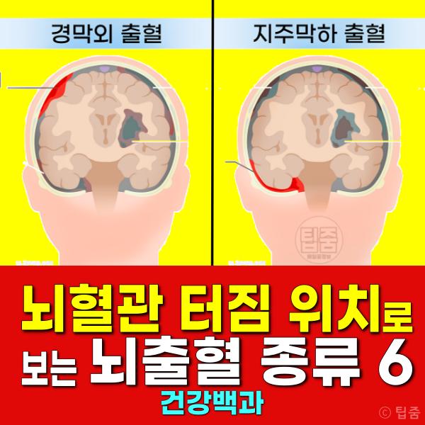 뇌혈관 터짐 위치 뇌출혈 종류