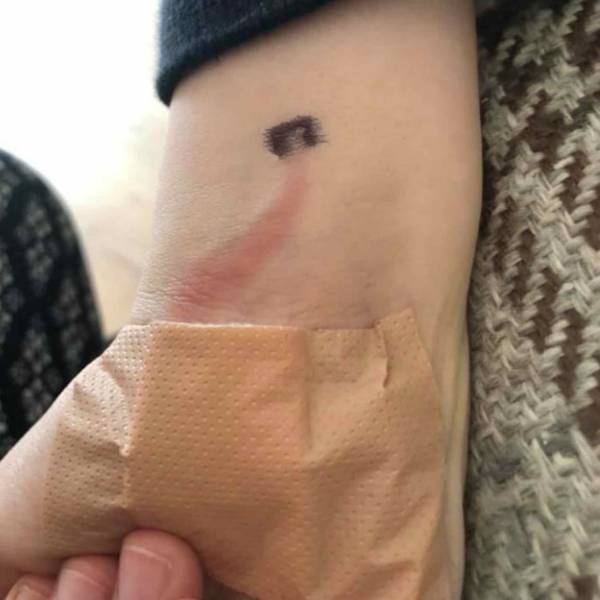 피부에 붉은 선,피부에 붉은자국,패혈증 증상,팁줌