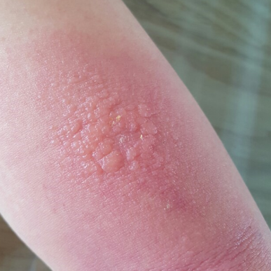 모기에 물린 자리가 크게 부어오른 모습 - 스키터증후군 발생