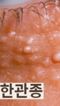 눈밑에 하얀 좁쌀