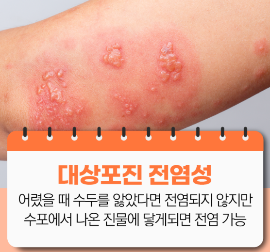 대상포진 전염성
