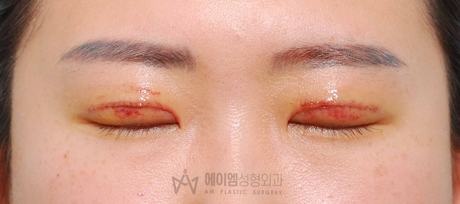 소세지눈 두줄따기 1주일