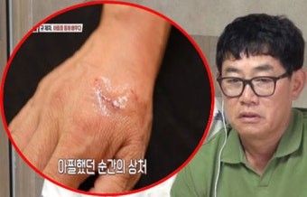 개통령-강형욱도-개에게-손등을-물려-흉터가-선명한-모습에-놀라는-이경규
