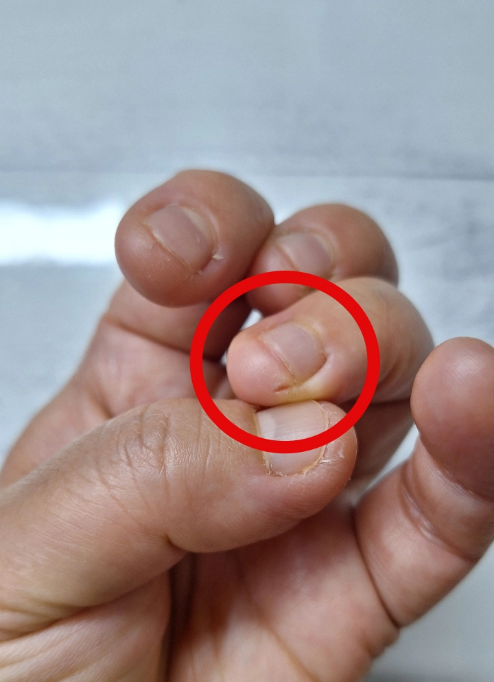 손끝-가벼운-갈라짐