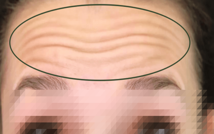 이마-보톡스-시술-전-여성의-모습 