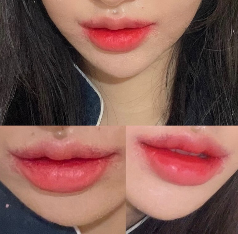 입술확대수술 후기