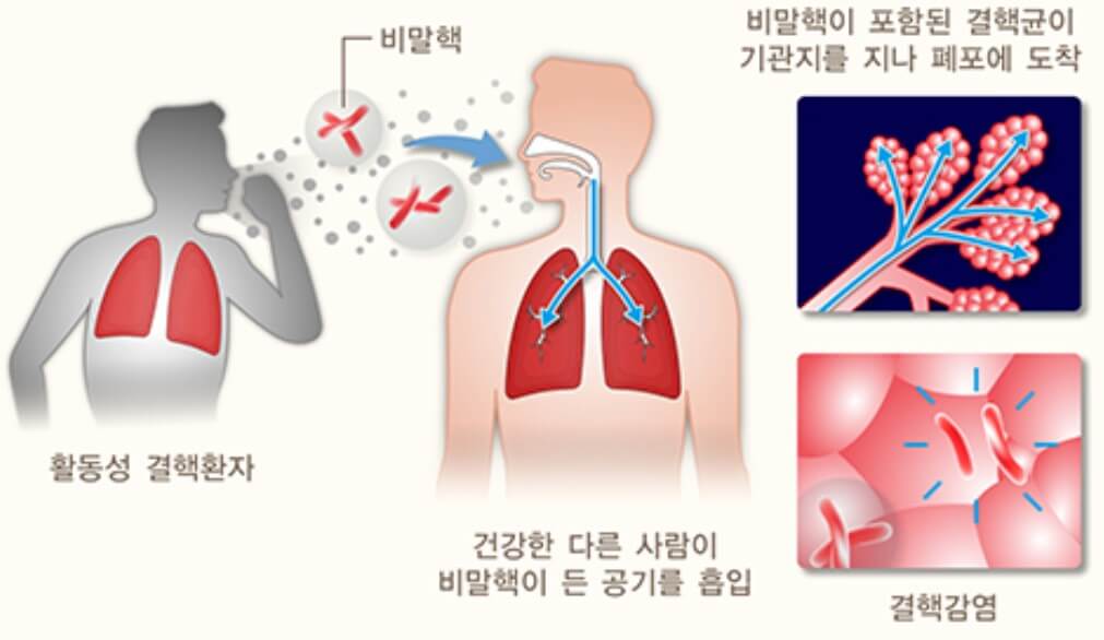잠복 결핵검사 및 증상&#44; 치료&#44; 비용까지 알아봤습니다. 한국에서 결핵은 남성보다 여성이 노인보다 젊은 세대에 더 많이 발생한다고 합니다. 중요하게 보는 원인은 음식이나 스트레스가 원인인 것으로 보고 있습니다. 어떤식으로 치료가 진행되는지 꼼꼼히 읽어 보시기 바랍니다.