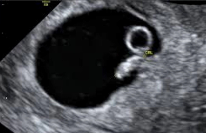 임신 6주차 증상