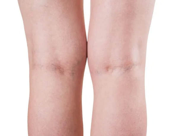 하지정맥류 원인&amp;#44; 증상&amp;#44; 치료와 예방