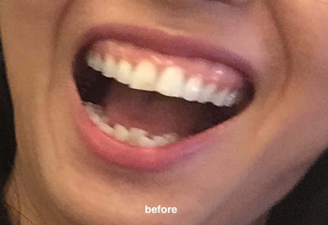 2년 7개월 교정 중 과개교합 돌출입 교정 일기