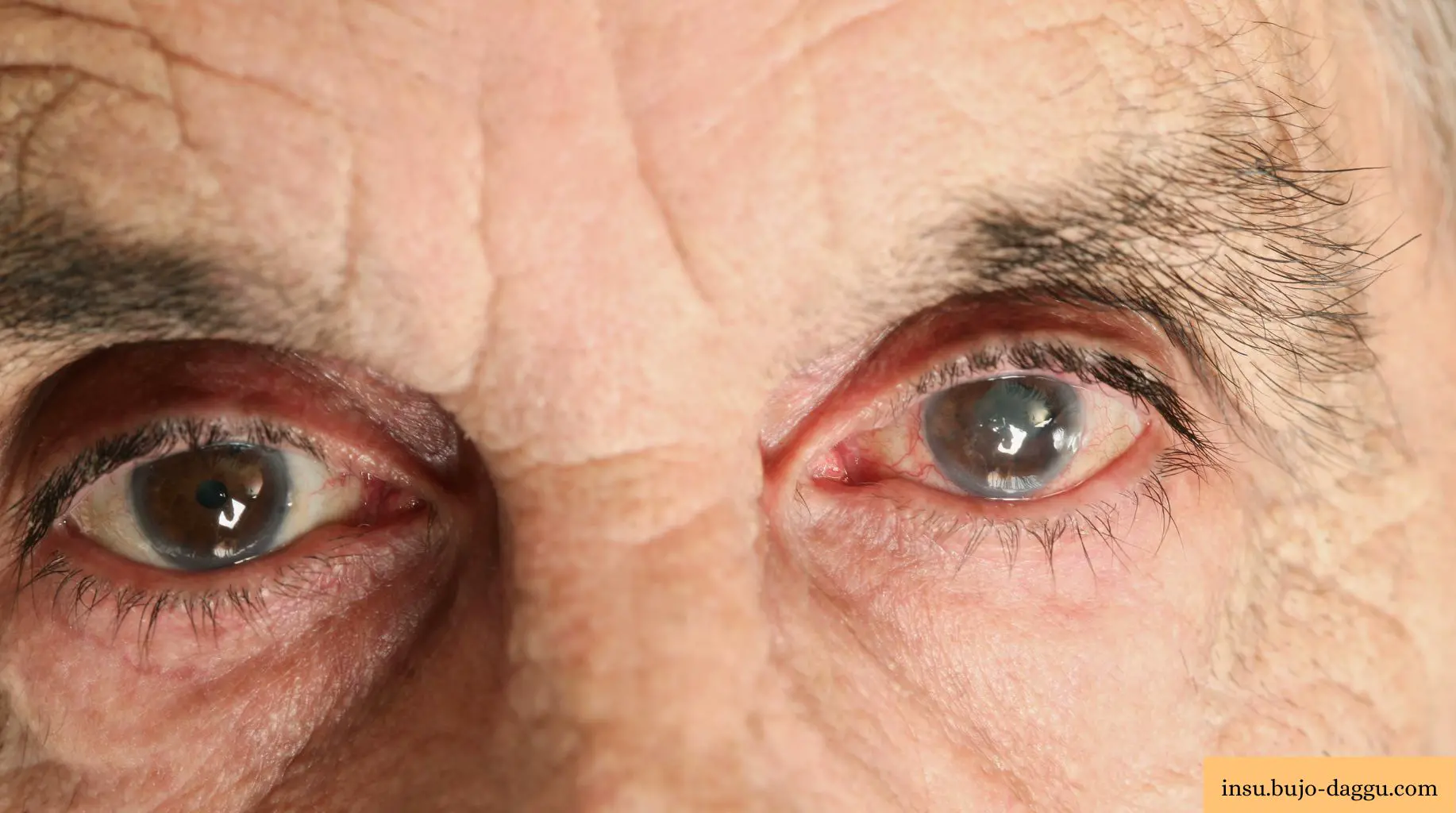 백내장 수술 실비 청구 서류 총정리｜진단서&middot;약제비&middot;다초점 렌즈까지 한 번에