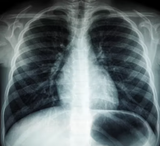 오른쪽 갈비뼈 아래 통증 원인 대처법