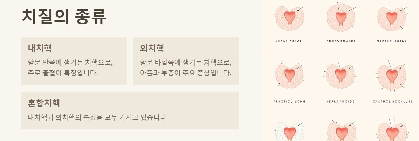 치질 증상 자가치료법