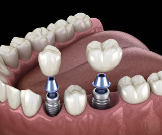 임플란트 시술과정