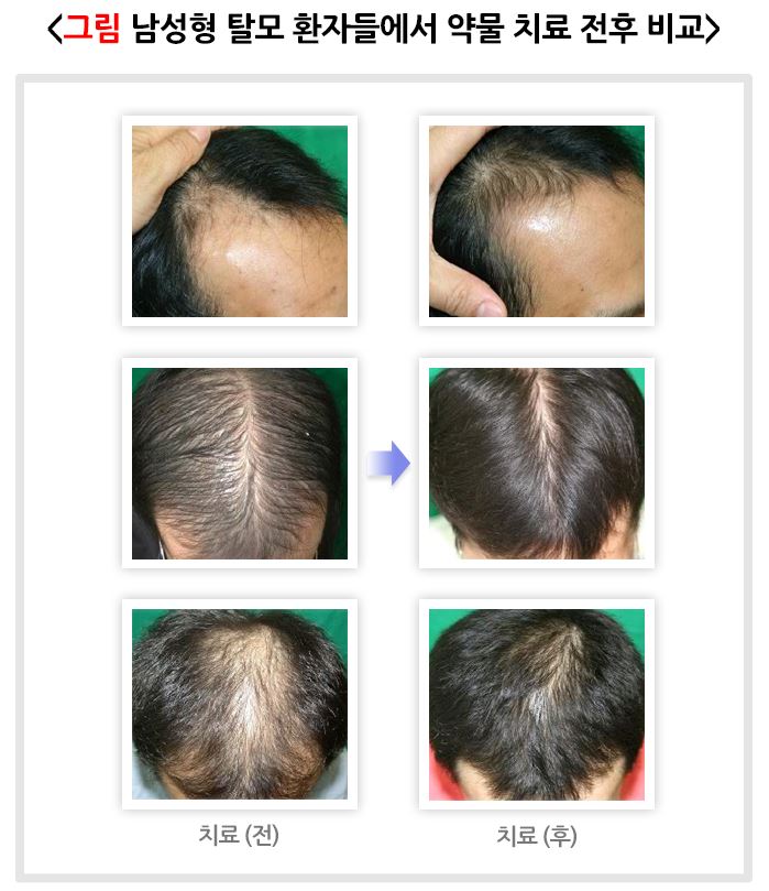 남성형-탈모-환자들에서-먁물치료-전후-비교한-탈모된-머리들의-사진
