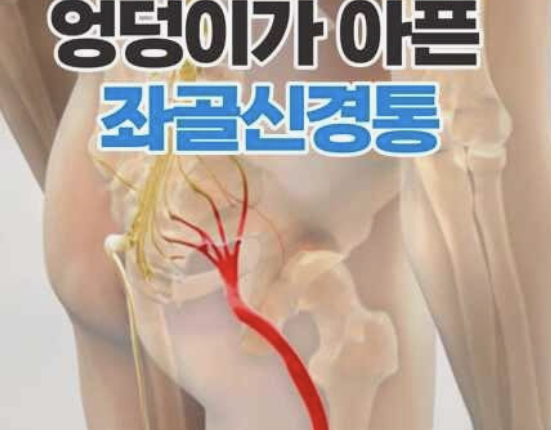 엉덩이 통증&amp;#44; 앉는 것도 고문이었던 3개월의 기록