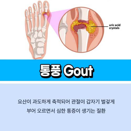 통풍에_좋은_영양제