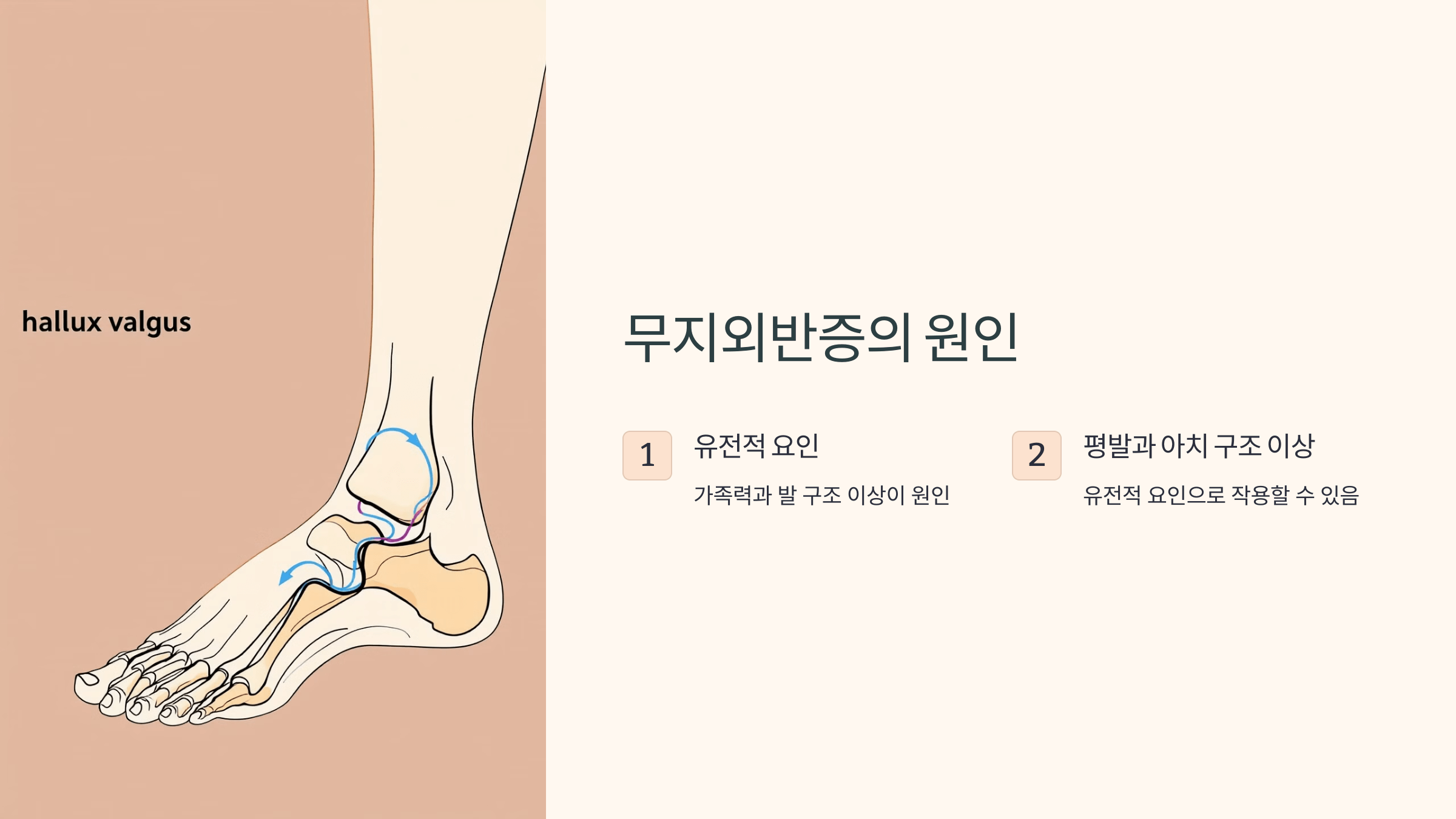 무지외반증과 관련된 사진입니다.