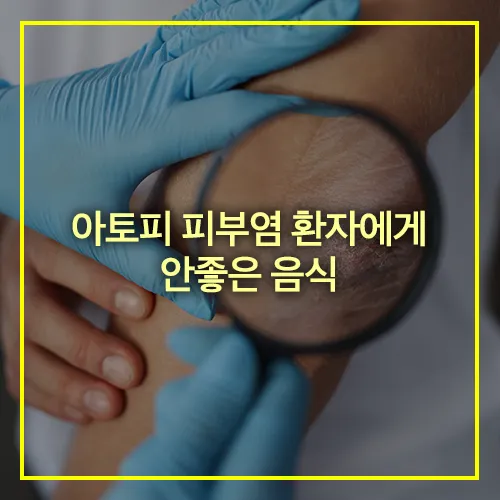 아토피 피부염 환자에게 안좋은 음식