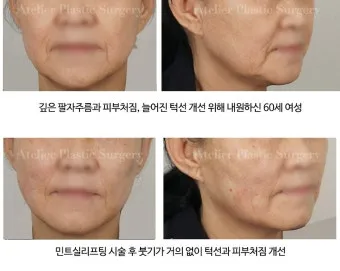 덴서티 리프팅 댄서티 가격 효과 유지기간에 관한 정보_13