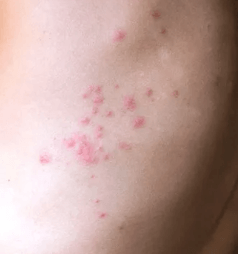 빈대에 물려 동그란 잡단모양 울긋불긋한 모양