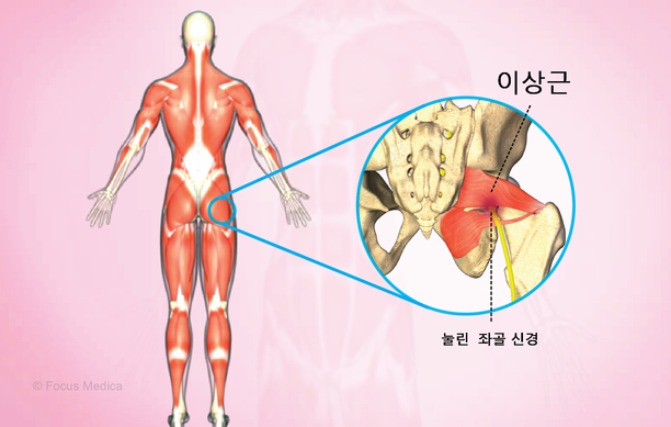 엉덩이의 피리꼴 근육에 의해 좌골신경이 자극되는 흔치 않은 신경근육 장애.