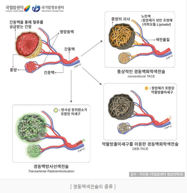 간암 치료 경동맥 색전술