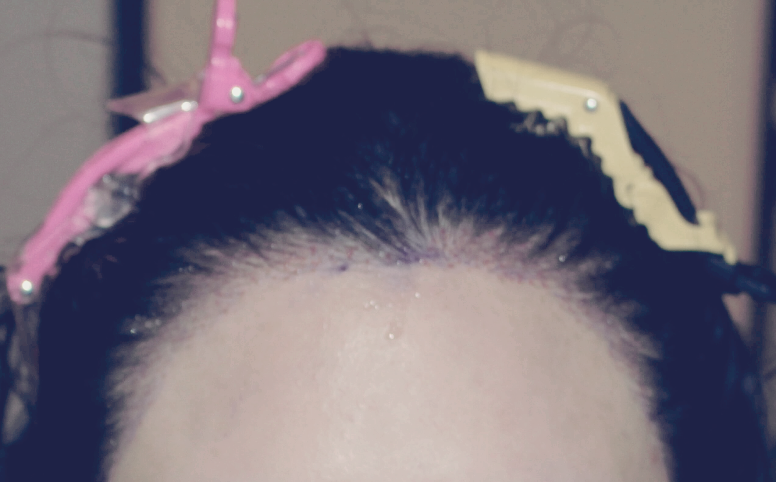 1차 보강 수술 후 정면