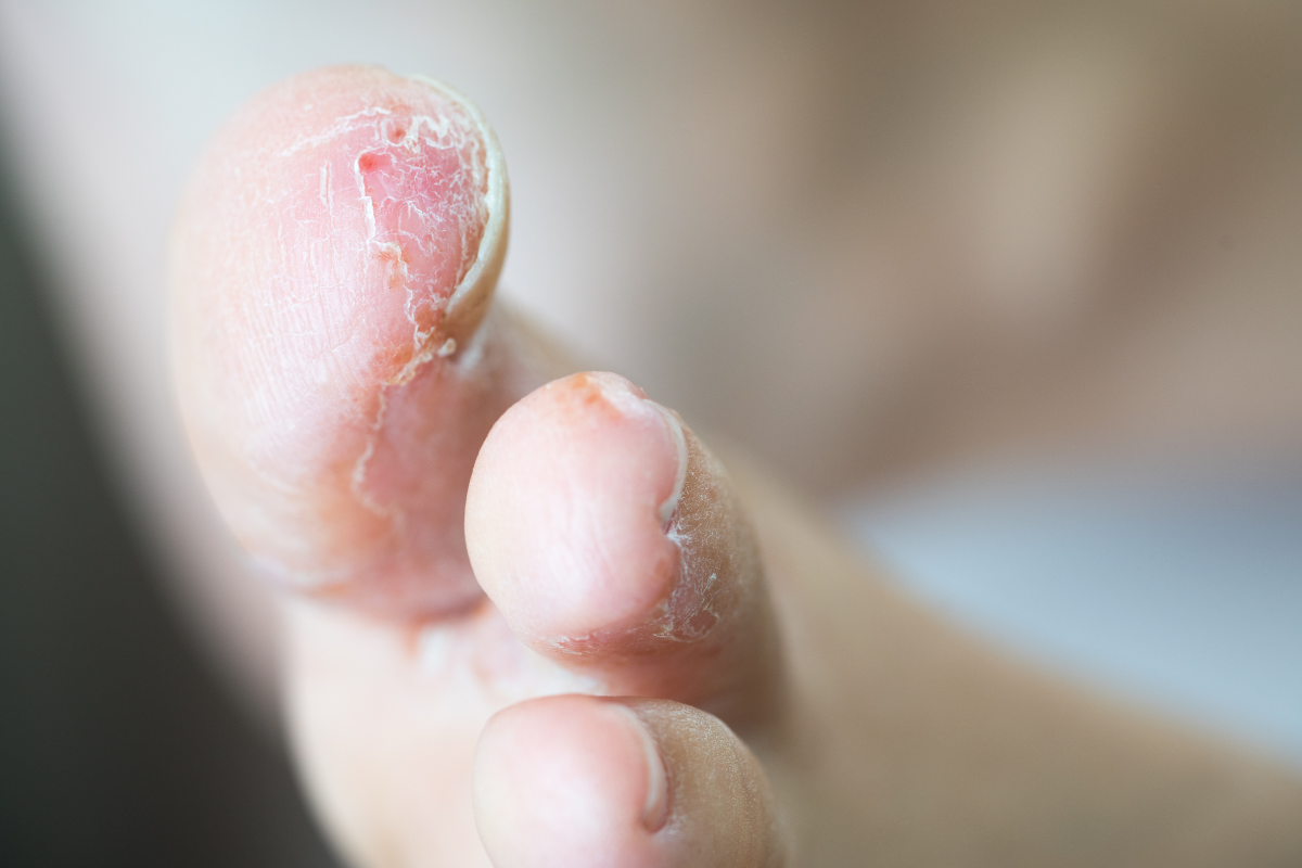 발가락 사이가 갈라지고 냄새가 날 때 무좀일까? 증상과 치료법