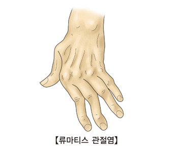 류마티스 관절염