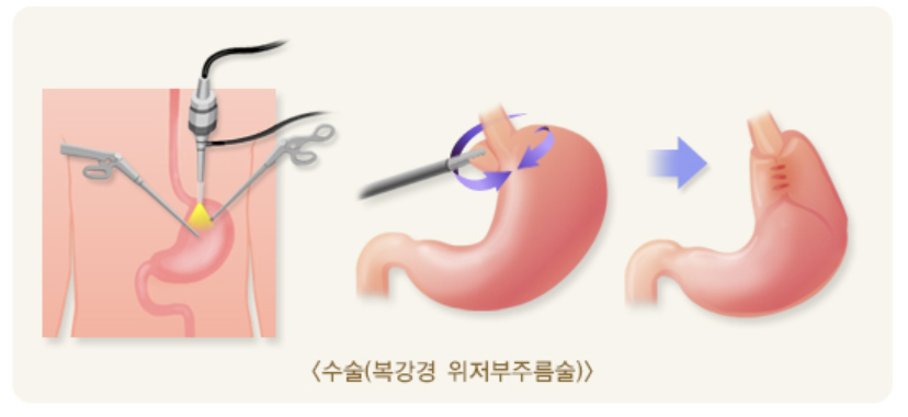 수술법
