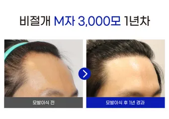 머리카락 이식 3000모 3000모낭 비용과 시술 과정_30